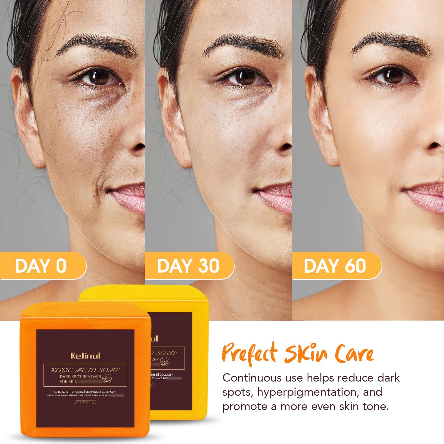 Kojic Acid Soap Dark Spot Remover Bars with Turmeric and Retinol, 9 oz 4 Bars G576109